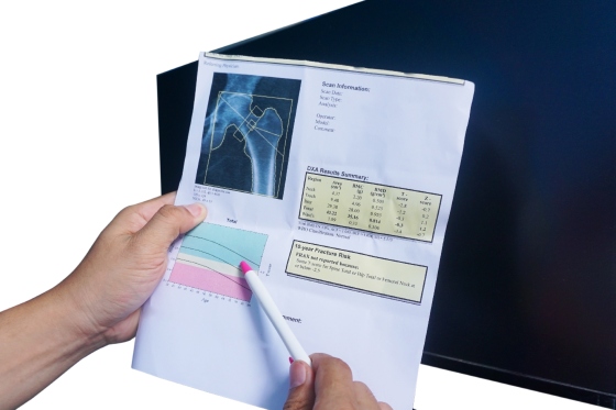 Osteodensiometrie (DEXA): cand si cui ii este recomandata aceasta investigatie?