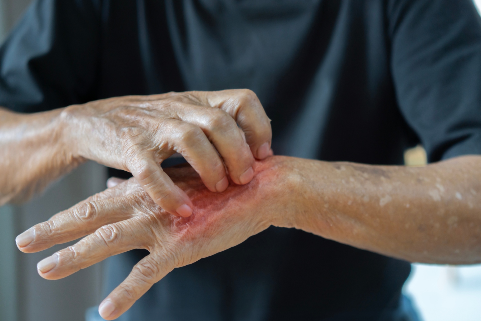 Sicozis stafilococic: cauze, simptome, tratament, complicatii