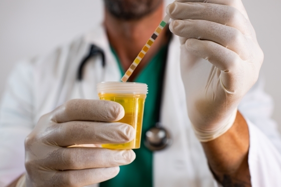Examenul de urina si intelegerea lui: Urina inchisa la culoare