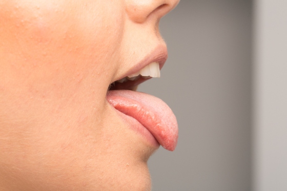 Sialoree: ce este, cauze si de ce apare salivatia excesiva