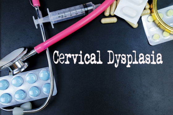 Displazie de col uterin: totul despre displazie cervicala