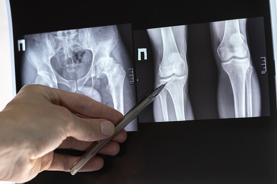 Ce este coxartroza? Manifestari clinice, factori de risc, diagnostic si tratament