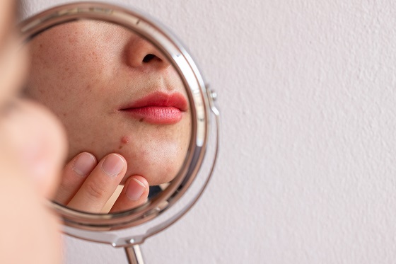 Cum sa evitati acneea cauzata de cosmetice