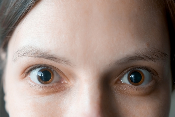 Pupile dilatate: ce probleme indica si ce remedii exista