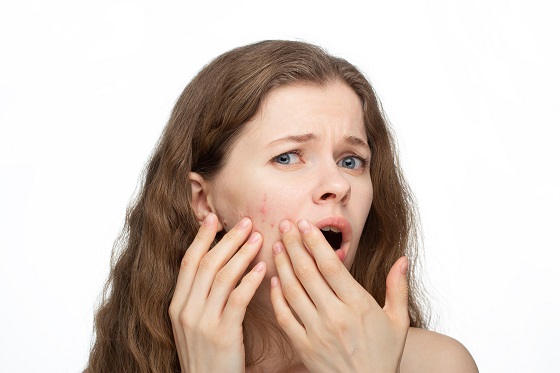 Top 7 solutii naturale pentru acnee