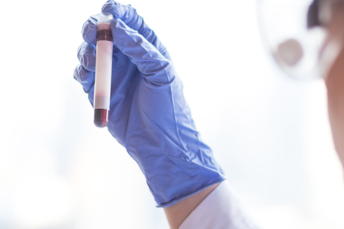 Ce este melioidoza? Simptome, cauze, diagnostic si tratament