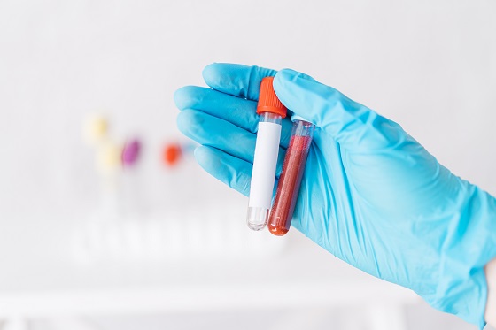 Informatii despre analizele de sange: hematocrit