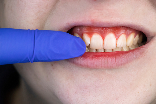 Sangerari gingivale: cauze, afectiuni asociate si tratament