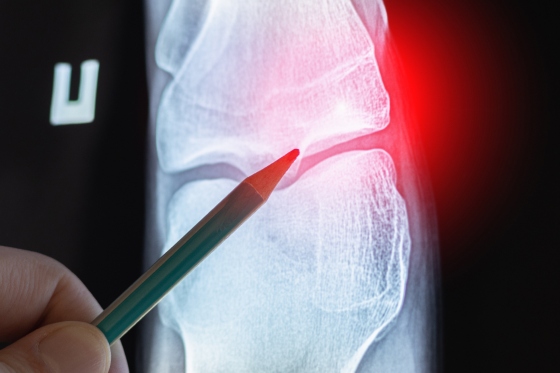 Osteom: ce este, cauze si factori de risc, tablou clinic, tratament