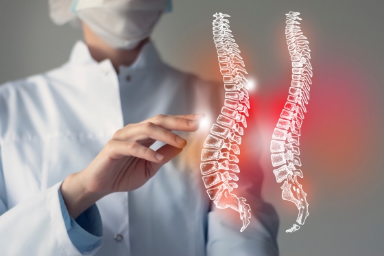 Ce este stenoza spinala si care sunt cauzele