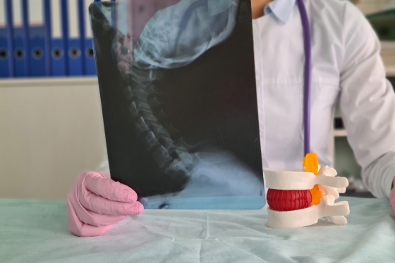 Mielodisplazie: cauze, factori de risc, simptome, diagnostic si tratament