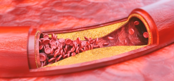 Ateroscleroza – ce este, care sunt cauzele si optiunile de tratament