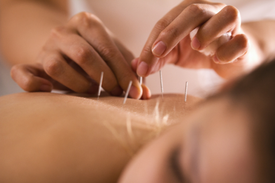 Acupunctura si beneficiile ei in tratamentul durerilor de spate