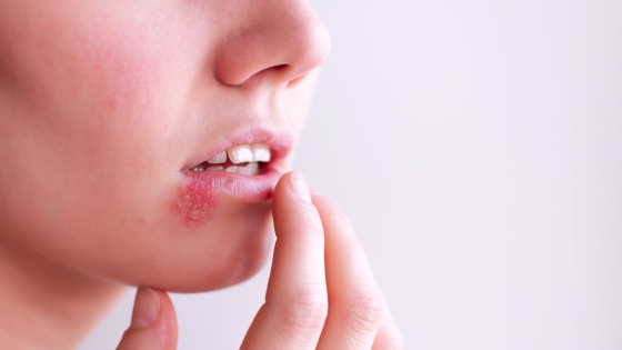 Herpes oral - simptome, cauze, tratament si preventie