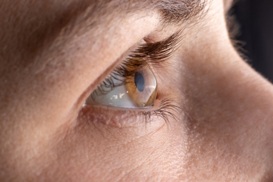 Keratoconus – factori de risc, cauze, manifestari, diagnostic si tratament