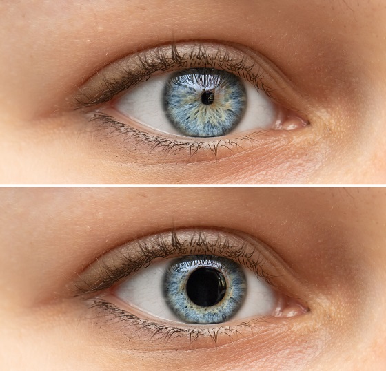 Mioza: cauze si tratament pentru micsorarea pupilelor
