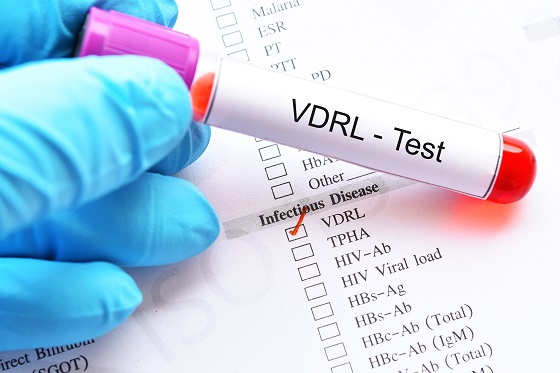VDRL: cum functioneaza testul si ce inseamna rezultatele pozitive?