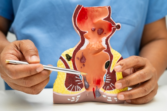 Cancer intestinal: ce este, tipuri si cum afecteaza sistemul digestiv