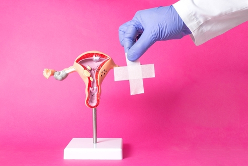 Endometrioza: mituri si adevaruri