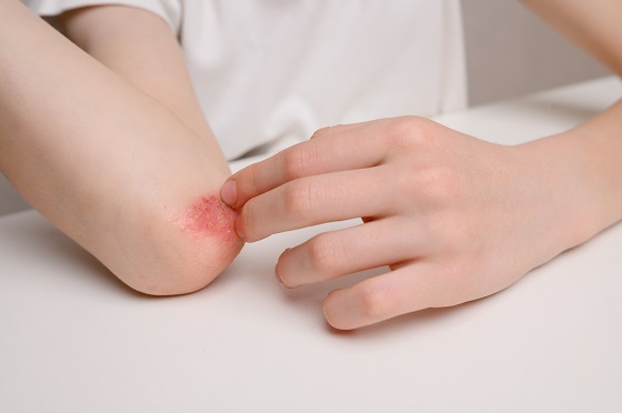 Prurigo actinic: simptome, cauze si factori de risc, diagnostic si preventie