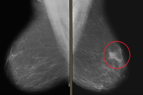 Carcinom ductal in situ (CDIS): clasificare, diagnostic imagistic si histopatologic, management