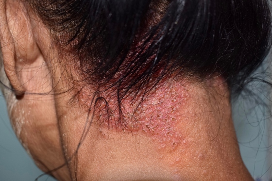 Pecingine: simptome, cauze, modalitati de tratament