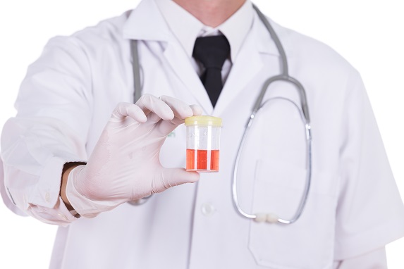 Sange in urina: cauzele si tratamentul hematuriei