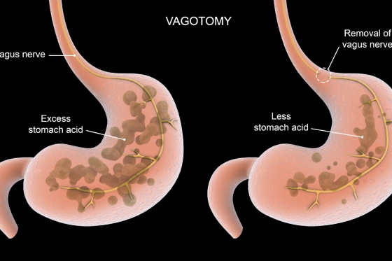 Vagotomie: indicatii si tipuri de proceduri