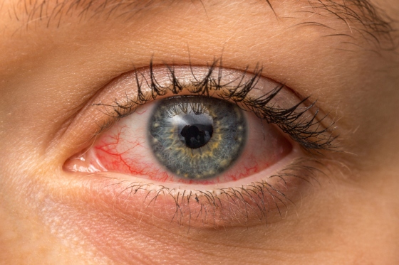 Ocluzia vasculara retiniana: tipuri, cauze, solutii de tratament