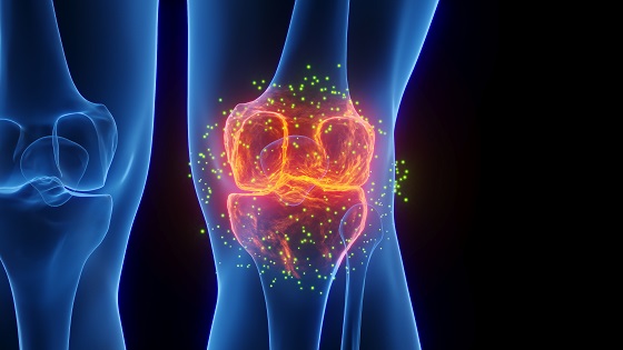(P) Gonartroza sau artroza genunchiului