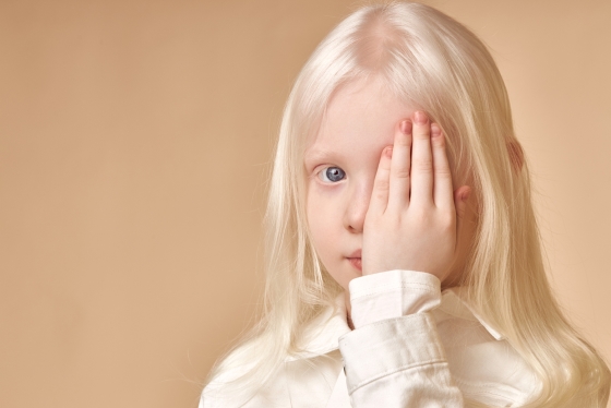 Ce trebuie sa stiti despre albinism: cauze si tratament