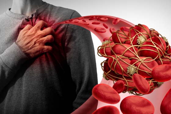Cheaguri de sange: tipuri, factori de risc, cauze si tratament
