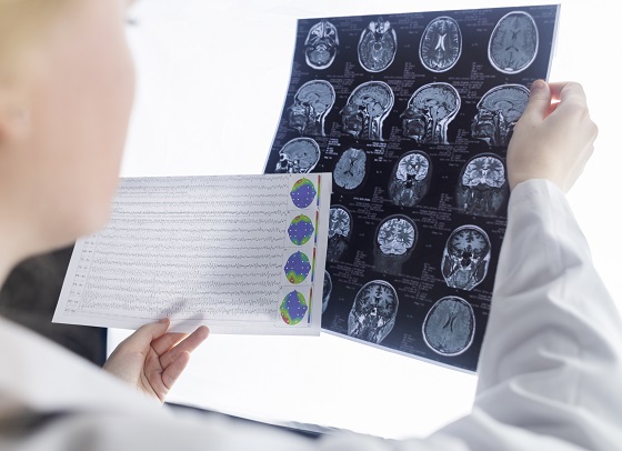 Electroencefalograma: ce este, ce rol are, cand se recomanda
