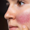 Ingrijirea pielii cu acnee rozacee: sfaturi pentru reducerea simptomelor