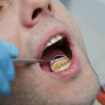 Tartru dentar - metode de preventie