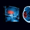 Atrofie cerebeloasa – cauze, simptome si tratament