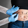 Totul despre procedura de liposuctie (lipoaspiratie) abdominala
