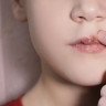 Herpes la copii – cauze, simptome si optiuni de tratament