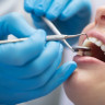 Placa dentara: ce este si cum poate fi indepartata placa bacteriana