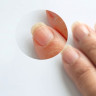 Micoza unghiei: cauze, factori de risc si remedii