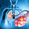 Alveolele pulmonare - rol, functii, patologii asociate