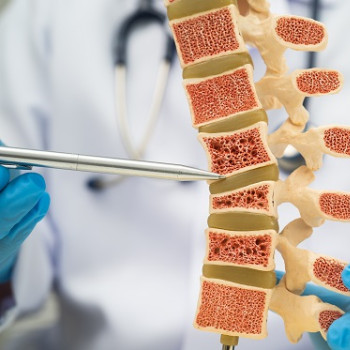 Totul despre calciu in osteoporoza: cat, cum si cand sa il administrati