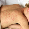 Rujeola la copiii vaccinati