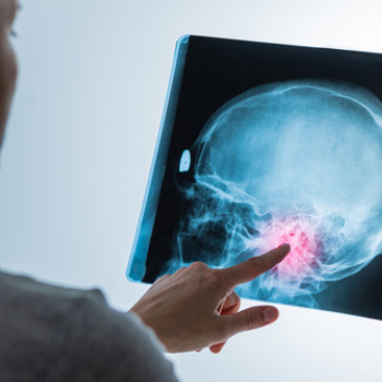 Sindrom Arnold Chiari: ce este si cum este diagnosticat