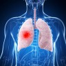 Tipologia abcesului pulmonar si tratamente corespunzatoare