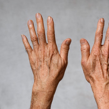 Ce este si cum tratati eczema degenerativa? Sfaturi medicale si solutii