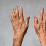 Ce este si cum tratati eczema degenerativa? Sfaturi medicale si solutii