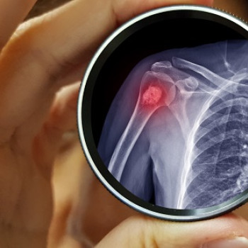 Encondrom: ce este, ce cauze are, diagnostic si tratament