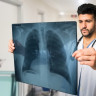 Emfizem pulmonar: cauze, simptome, diagnostic si tratament