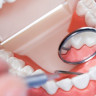 Odontoliza sau eroziunea dentara: cauze si solutii